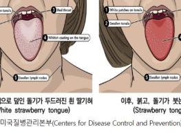 청주시 '갑자기 열나고 딸기혀 보이면 '성홍열' 의심하세요' 기사 이미지